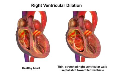Sağ ventriküler genişlemeye kıyasla sağlıklı kalp, üç boyutlu illüstrasyon. Genişleme akciğer hipertansiyonuna, kronik akciğer hastalığına, sağ kalp yetmezliğine ve aritmiye bağlı..