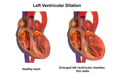 Sol ventriküler genişleme, sağlıklı kalp ve genişlemiş karıncığı karşılaştıran üç boyutlu çizim. Sistolik kalp yetmezliği, kardiyomiyopati, azalan atım fraksiyonu ve aritmiye bağlı durum..