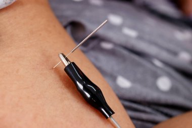 Vietnamese traditional medicine clinic. Acupuncture treatment. Cu Chi. Vietnam. 