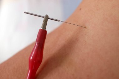 Vietnamese traditional medicine clinic. Acupuncture treatment. Cu Chi. Vietnam. 