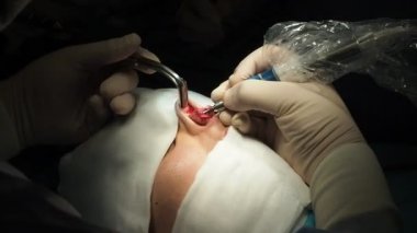 Kara ameliyathanede ultrasonik rinoplasti ameliyatı sırasında hastaların burun kemiklerini yeniden şekillendirmek için piezotomi kullanan isimsiz cerrahların el kamerasından.