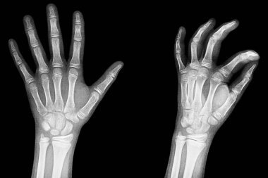 Ellerin röntgeni, parmak ve eklemlerin detayları, trapez, skafoid, piramit, Pisiform, kapitate, distal, frontal, proksimal, interflaginian, lunate, interheadheadate