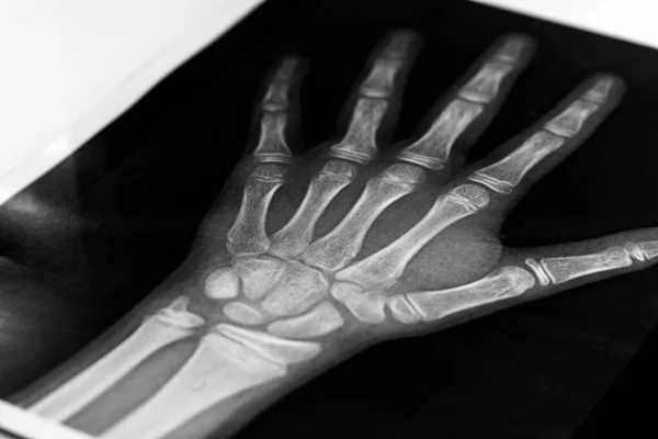 x-ray of the hands, detail of the phalanges and joints,trapeze,scaphoid,Pyramidal,Pisiform,capitate, distal, frontal, proximal, interflaginian, lunate, intercapitate