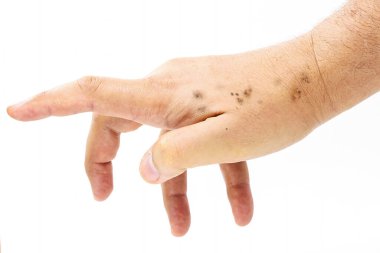 Erkek eli, kuru ve deri lekeleri, dermatolojik sorun, güneş melanozu başlıyor, güneş kremi sürmeyen deri, beyaz arka planda izole edilmiş.,