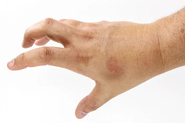 Mão Masculina Seca Com Manchas Pele Problema Dermatológico Início Melanose — Fotografia de Stock
