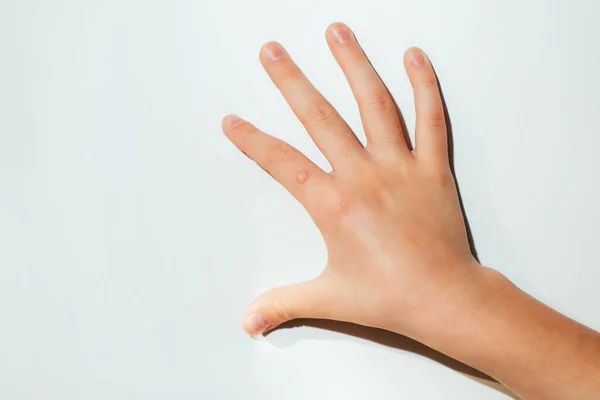 stock image Childrens hand with a wart on a white background. Papilomavirus. View from above