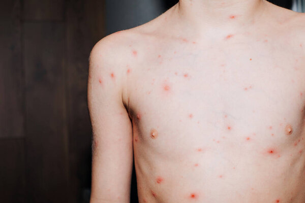 Viral diseases with a rash on the body. Chickenpox on the childs body. Treatment of chickenpox. Front view