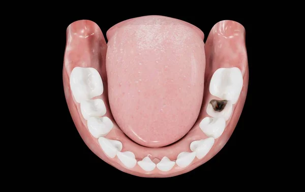 denture with dental caries in tooth on black background