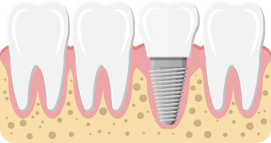 Diş yenileme, diş implantı.