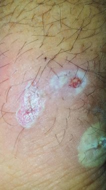 Şeker hastalığı yarası, kabarcıklar, sivilceler, enfeksiyonlar, ayağındaki döküntüler. Enfekte olmuş bir yara, diyabetik bir hastanın bacak enfeksiyonunun tedavisi. Cilt kaşıntısı, deri hastalığı, hastada deri sorunları