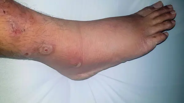 Şeker hastalığı yarası, kabarcıklar, sivilceler, enfeksiyonlar, ayağındaki döküntüler. Enfekte olmuş bir yara, diyabetik bir hastanın bacak enfeksiyonunun tedavisi. Cilt kaşıntısı, deri hastalığı, hastada deri sorunları
