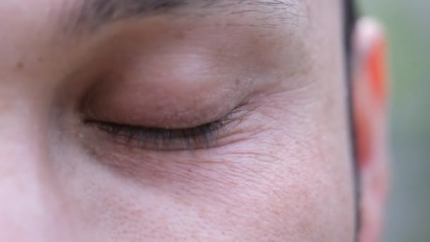 Глазное Заболевание Плотью Внутри Глаза Закрыть Pterjium — стоковое видео