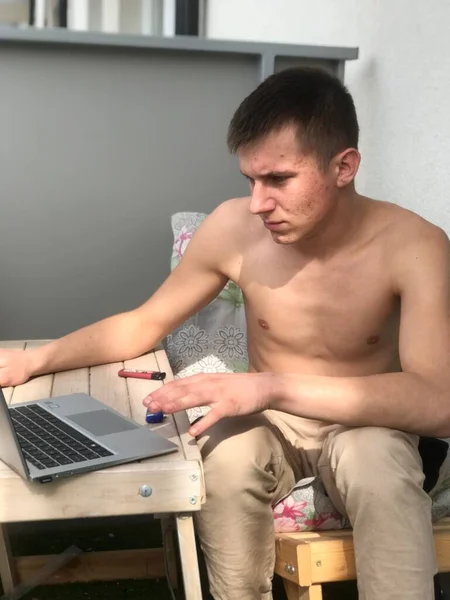 Jovem Adulto Com Tronco Acne Seu Rosto Senta Varanda Laptop — Fotografia de Stock
