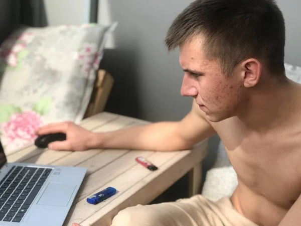 Jovem Adulto Com Tronco Acne Seu Rosto Senta Varanda Laptop — Fotografia de Stock