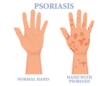Psoriasis, healthy and unhealthy hand. Dermatology. The concept of medicine and healthcare. Poster, banner, vector