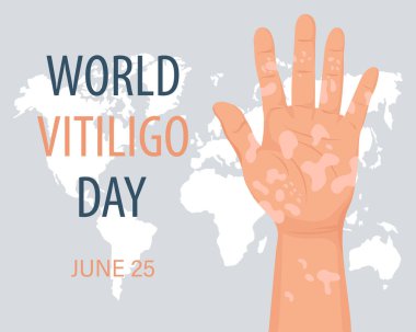 Hand with dermatological disease vitiligo. Medicine concept. World vitiligo day, awareness banner. Banner, poster, vector
