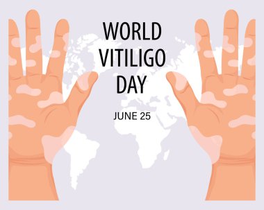 Hand with dermatological disease vitiligo. Medicine concept. World vitiligo day, awareness banner. Banner, poster, vector