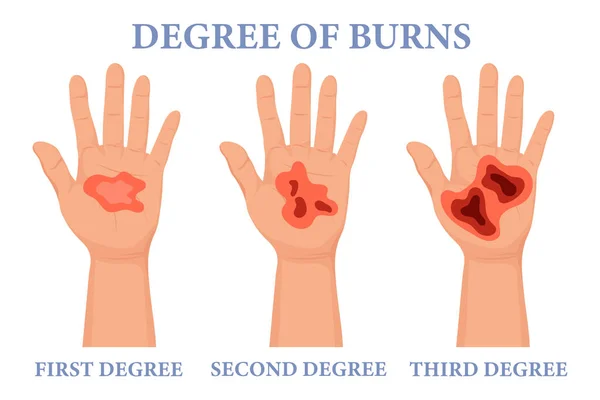 Burn Stages Burnt Hands Various Degrees Skin Burn Symptoms Medical — Stock Vector