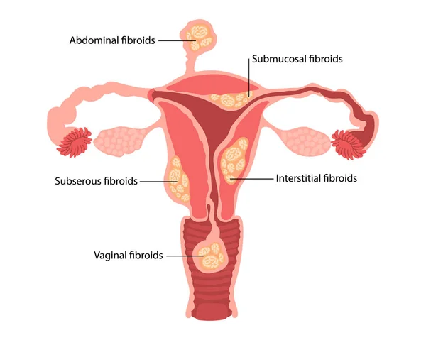 stock vector Diagram of types of uterine fibroids of a woman on a white background. Genicolgia. Medical concept. Infographics banner. Vector