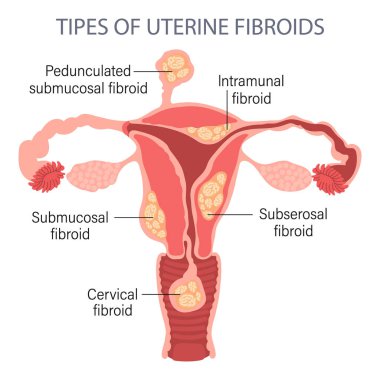 Diagram of types of uterine fibroids in a woman on a white background. Genicolgia. Medical concept. Infographic banner. Vector