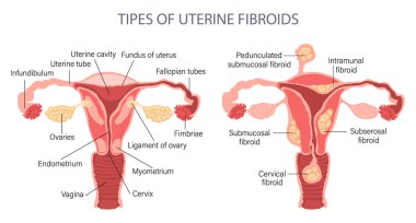 Diagram of types of uterine fibroids in a woman. Healthy and unhealthy uterus. Genicology. Medical concept. Infographic banner. Vector