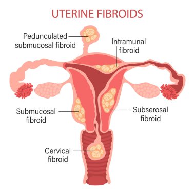 Types of uterine fibroids in women. Fibroids. Diseases of the female reproductive system. Gynecology. Medical concept. Infographic banner. Vector