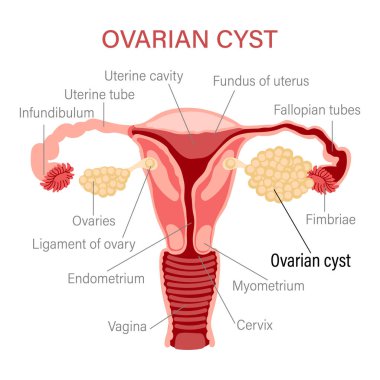 Ovarian cyst. Diseases of the female reproductive system. Gynecology. Medical concept. Infographic banner. Vector