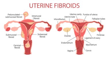 Types of uterine fibroids in women. Fibroids. Diseases of the female reproductive system. Healthy and unhealthy uterus. Gynecology. Medical concept. Infographic banner. Vector