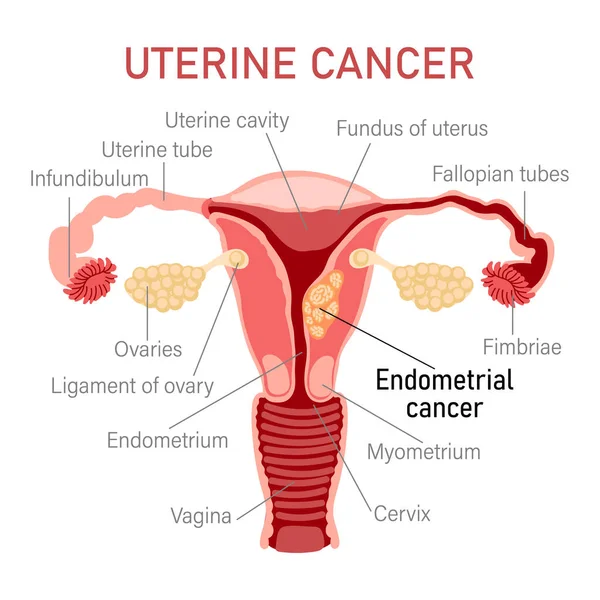 Uterine Cancer Diseases Female Reproductive System Gynecology Medical Concept Infographic — Vetor de Stock