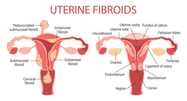 Types of uterine fibroids in women. Fibroids. Diseases of the female reproductive system. Healthy and unhealthy uterus. Gynecology. Medical concept. Infographic banner. Vector