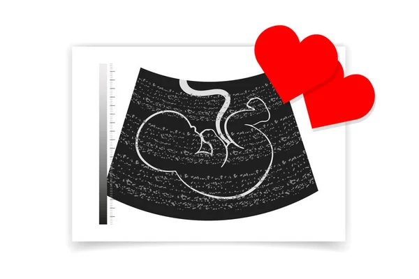 Φωτογραφία Από Υπέρηχο Εμβρύου Αγέννητου Μωρού Και Κόκκινες Καρδιές Εικονογράφηση — Διανυσματικό Αρχείο