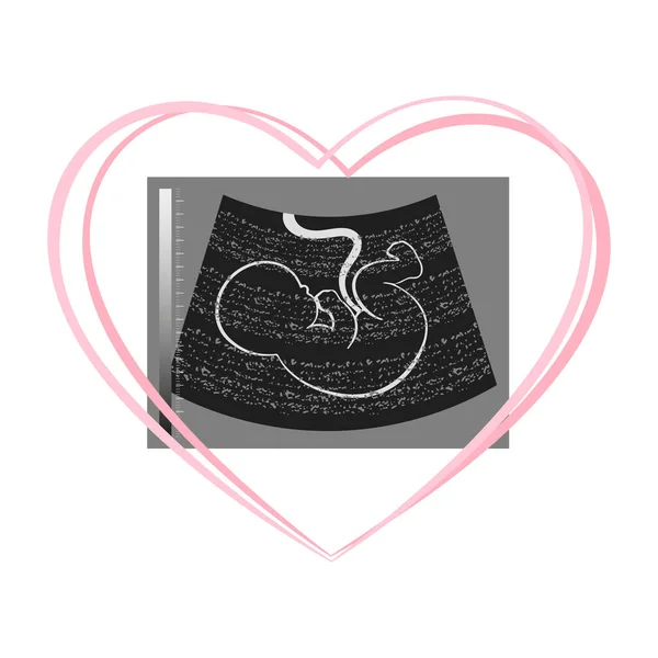 Ultraschallbild Eines Ungeborenen Embryos Einem Rosafarbenen Herzen Illustration Postkarte Vektor — Stockvektor