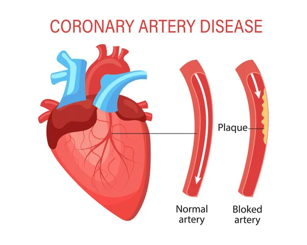 Enfermedad Arteria Coronaria Del Corazón Anatomía Humana Concepto Médico Infografías — Vector de stock