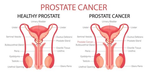Prostatacancer Manligt Fortplantningssystem Anatomi Människans Inre Organ Infographic Banner Diagram — Stock vektor
