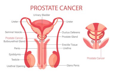Prostat kanseri. Erkek üreme sistemi. İnsan iç organlarının anatomisi. Bilgi pankartı, diyagram, vektör