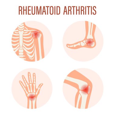Rheumatoid arthritis icons. Knee joint, shoulder joint, wrist joint, foot joint. Types of arthritis. Medical concept. Vector clipart