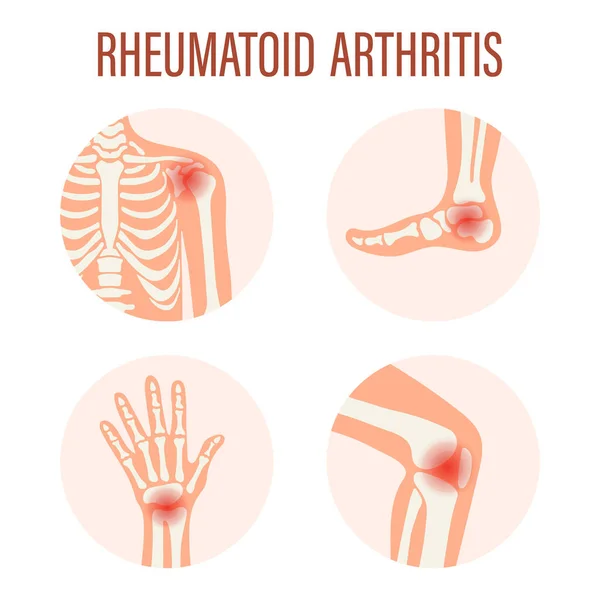 Iconos Artritis Reumatoide Articulación Rodilla Articulación Hombro Articulación Muñeca Articulación — Vector de stock
