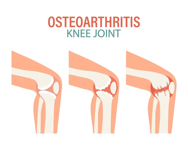 stock vector Rheumatoid arthritis. Osteoarthritis of the knee joints. Medical concept. Infographic poster, banner, vector