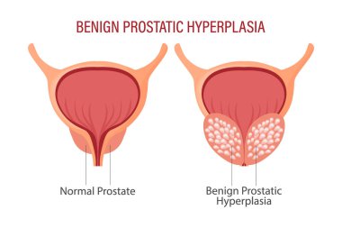 İyi huylu protez hiperplazi. İnsan organlarının anatomisi. Tıp, sağlık ve bilim konsepti. Eğitim bilgi grafikleri pankartı