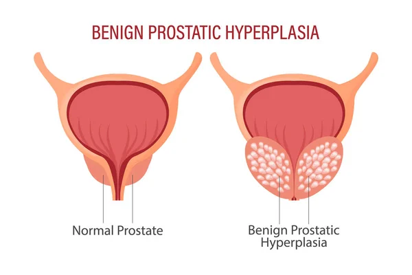 Hiperplasia Prostática Benigna Anatomía Órganos Humanos Concepto Medicina Salud Ciencia — Vector de stock