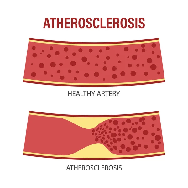 Vasos Sanos Ateroscleróticos Con Células Sanguíneas Colesterol Los Vasos Sanguíneos — Vector de stock