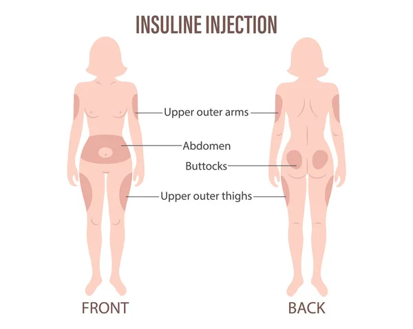 Diabète Sites Injection Insuline Sur Corps Humain Haut Des Bras — Image vectorielle