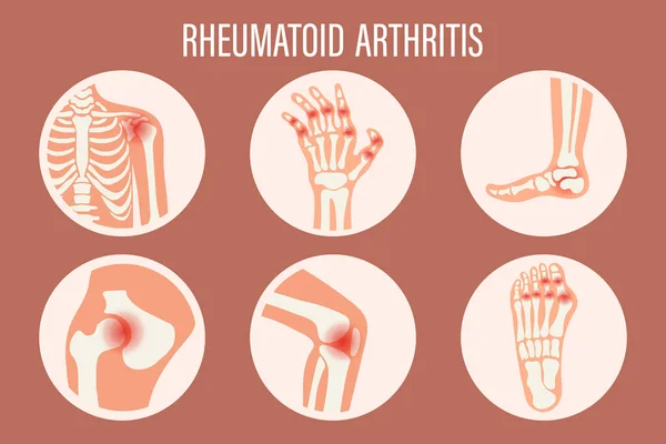 Iconos Artritis Reumatoide Rodilla Hombro Muñeca Cadera Pie Tipos Artritis — Vector de stock