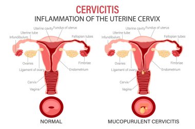 Rahim ağzı iltihabı, kadın üreme sistemindeki hastalıklar. Rahmin ve rahim boynunun şematik temsili. Tıbbi bilgi pankartı. Vektör