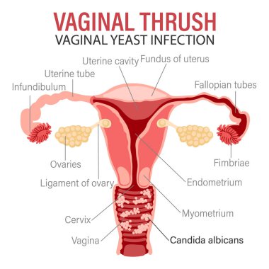 Kadın üreme sistemi hastalıkları, vulvovaginal kandiyoz ya da vajinal mantar enfeksiyonu. Tıbbi bilgi pankartı. Vektör