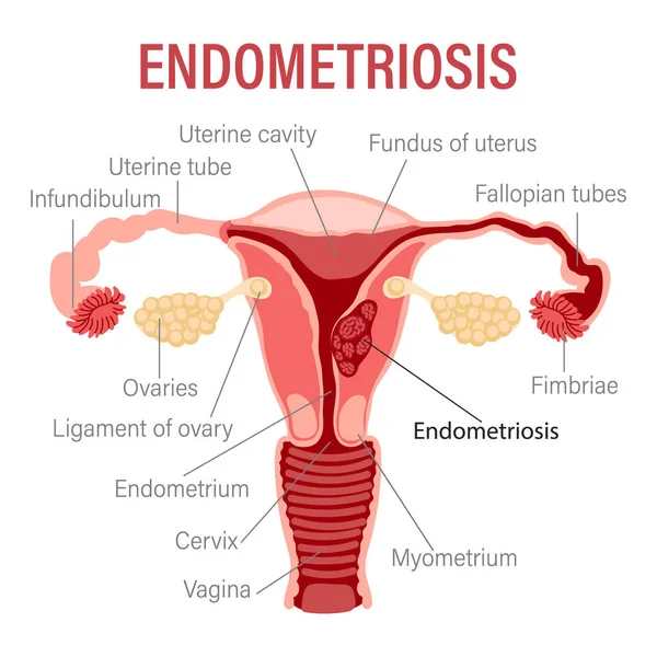 Endometriyozis Rahmin Şematik Çizimi Kadın Üreme Sisteminin Hastalıkları Tıbbi Bilgi — Stok Vektör