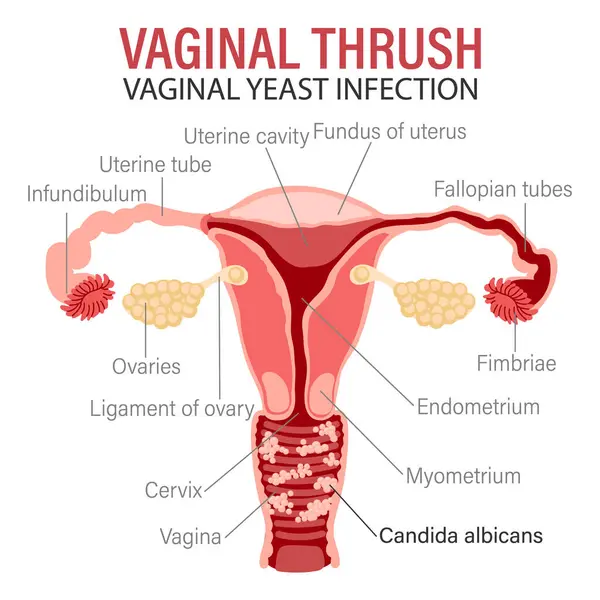 Kadın Üreme Sistemi Hastalıkları Vulvovaginal Kandiyoz Vajinal Mantar Enfeksiyonu Tıbbi — Stok Vektör