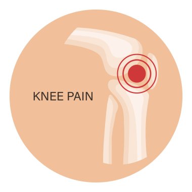 Diz ağrısı, osteoartrit, romatoid artrit. İnsan kemiklerinin anatomisi. İlaçlar. Görüntü, vektör