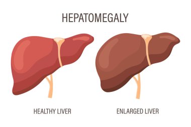 Hepatomegali, karaciğer hastalıkları. Sağlıklı karaciğer ve büyümüş karaciğer. Tıbbi bilgi pankartı. Vektör