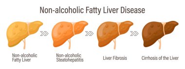 Yağlı karaciğer türleri. İnsan karaciğer hastalıkları. Alkolsüz yağlı karaciğer hastalığı. Hepatit, karaciğer sirozu, fibroz, steatoz. Tıbbi bilgi pankartı. Vektör